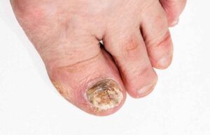 One Cup of This Will Destroy Your Nail Fungus